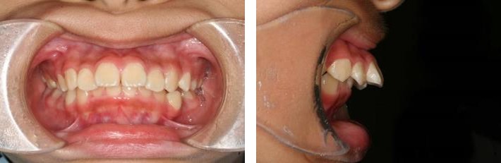 顎が小さい症状 上顎前突 に対して使用する矯正装置は なんぽ歯科クリニック新百合ヶ丘 新百合ヶ丘の矯正専門歯科医院